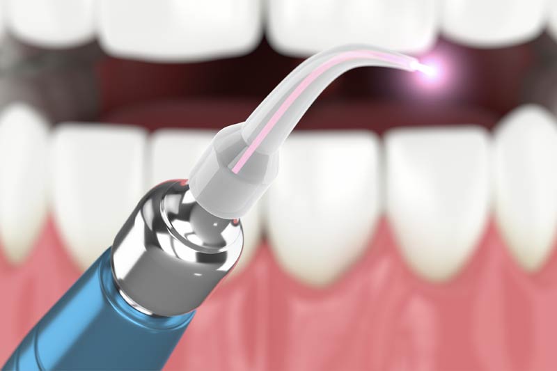 Laser Dentistry in Lancaster